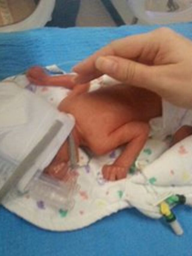 24 Weeks Premature Baby What Happened After Discharge?